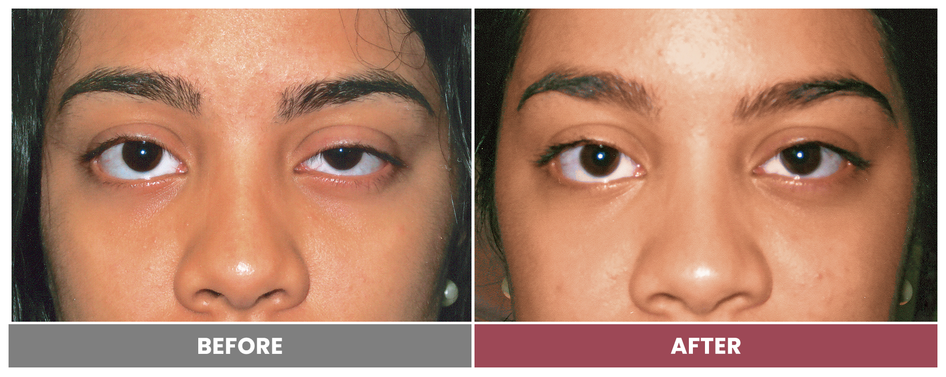 PTOSIS REPAIR - Case 46